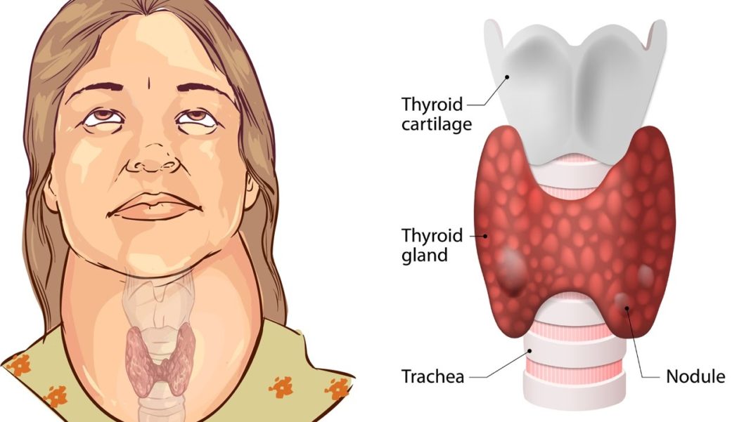 7-warning-signs-you-may-have-a-thyroid-problem